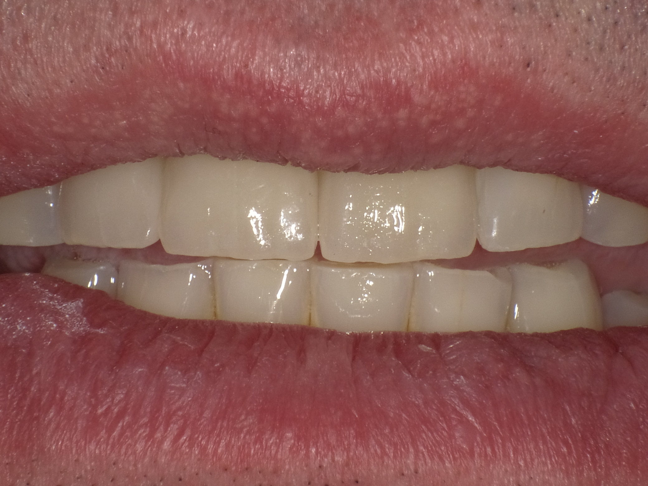 Rekonstruktion mit vollkeramischen Kronen